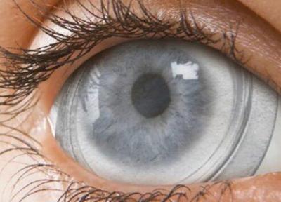 فراوری پانسمان چشمی با سلول بنیادی جفت جنین