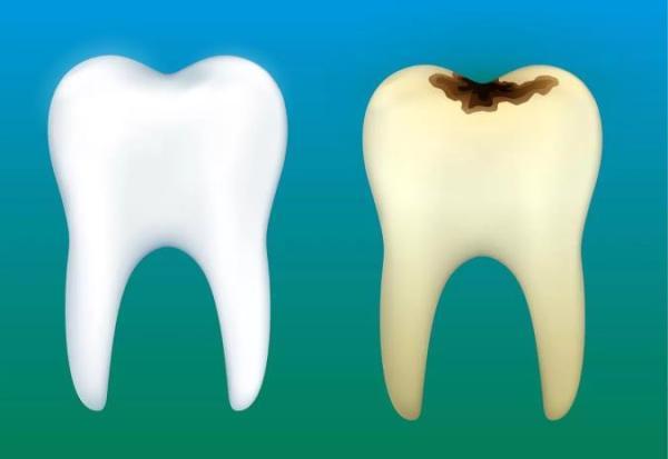 با نشانه های پوسیدگی دندان آشنا شوید
