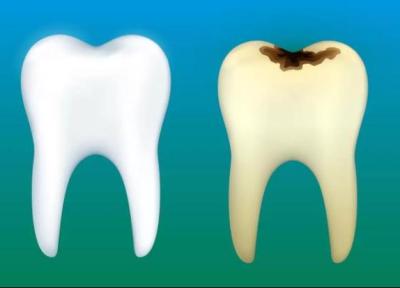 با نشانه های پوسیدگی دندان آشنا شوید